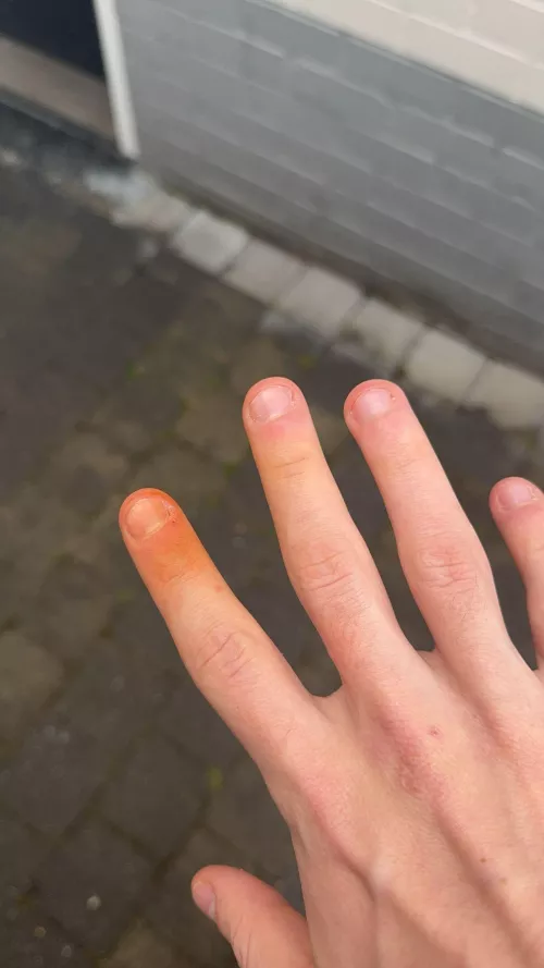 Why is my finger suddenly orange