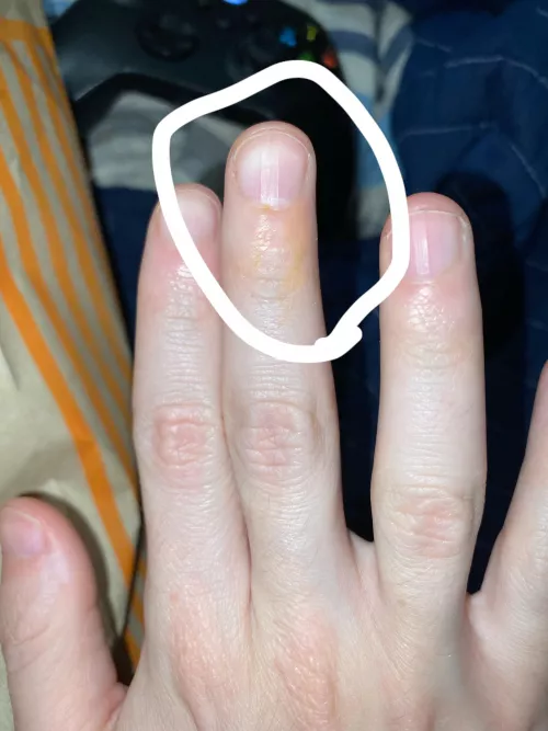 Why is my finger turning yellow?