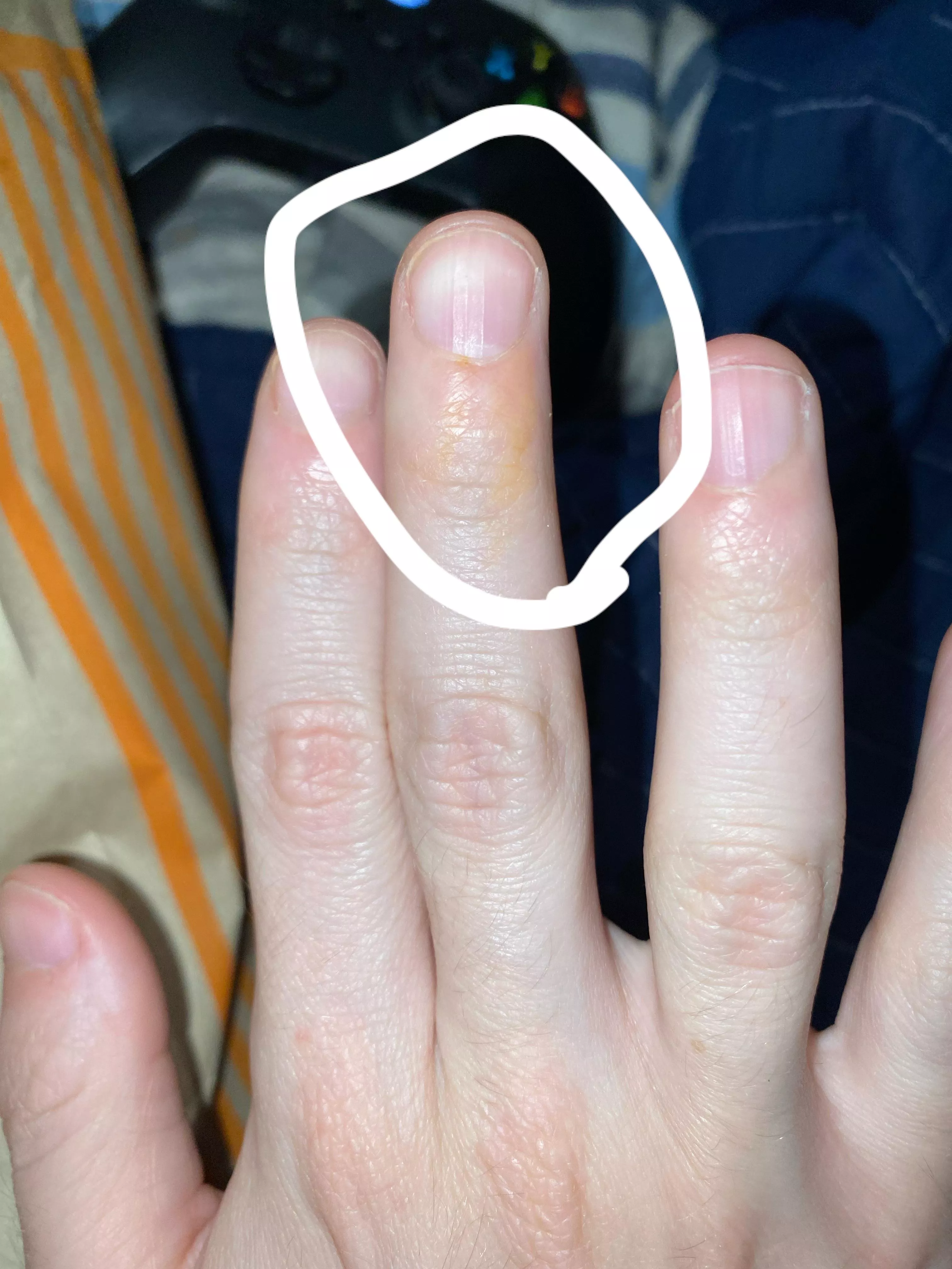 Why is my finger turning yellow?