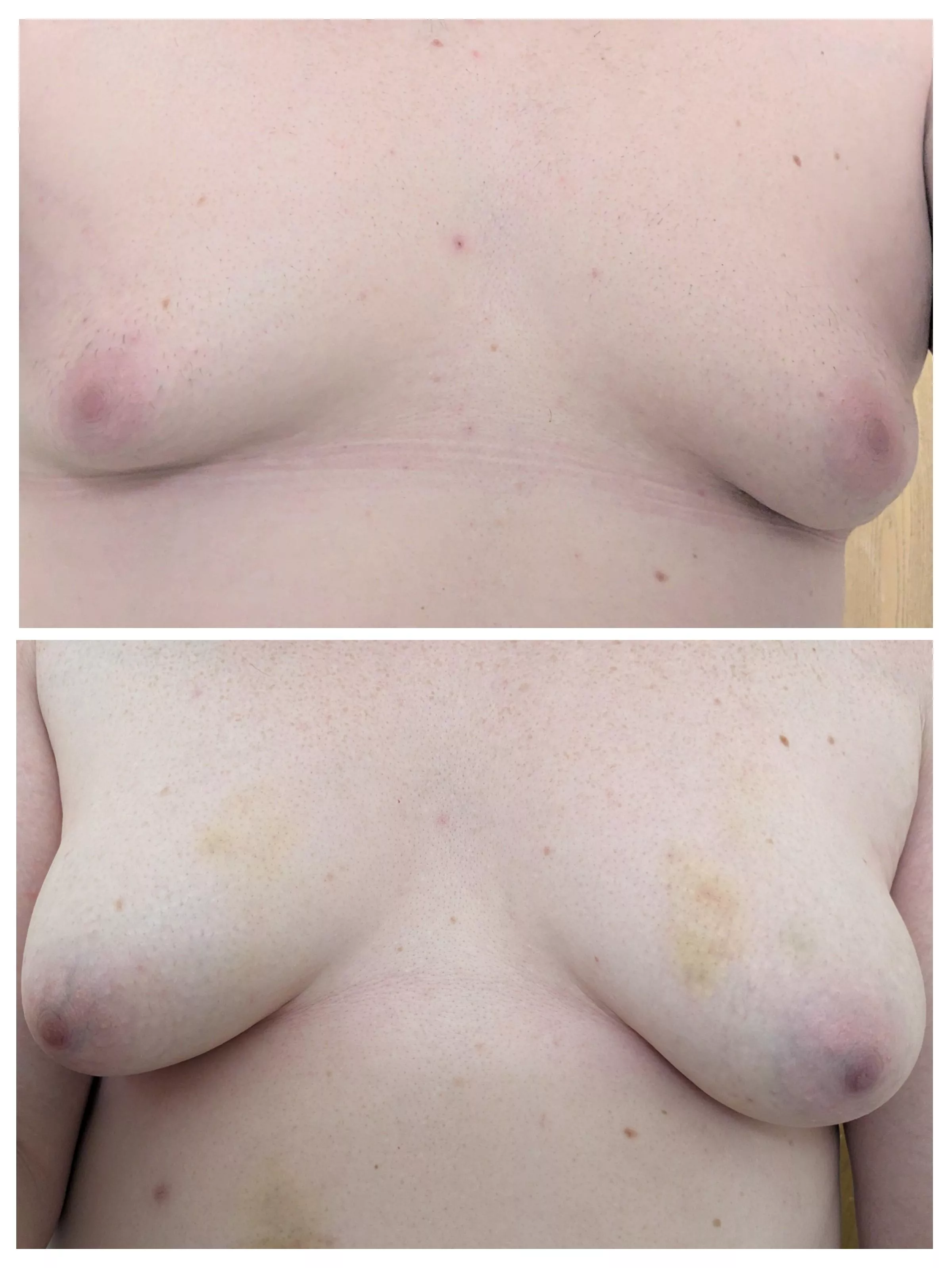 Pre-hrt Gynaecomastia 0 months to 10 months.