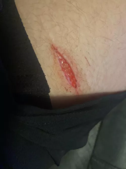 Bad enough for stitches?