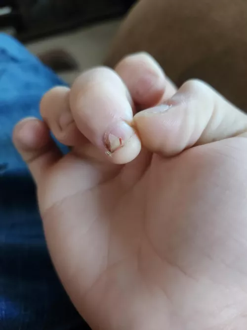 Broken my nail in a sink drain