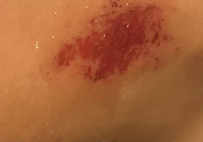 Got burnt and tripped during a camp fire