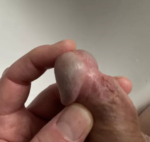 Frenulum removed after circumcision