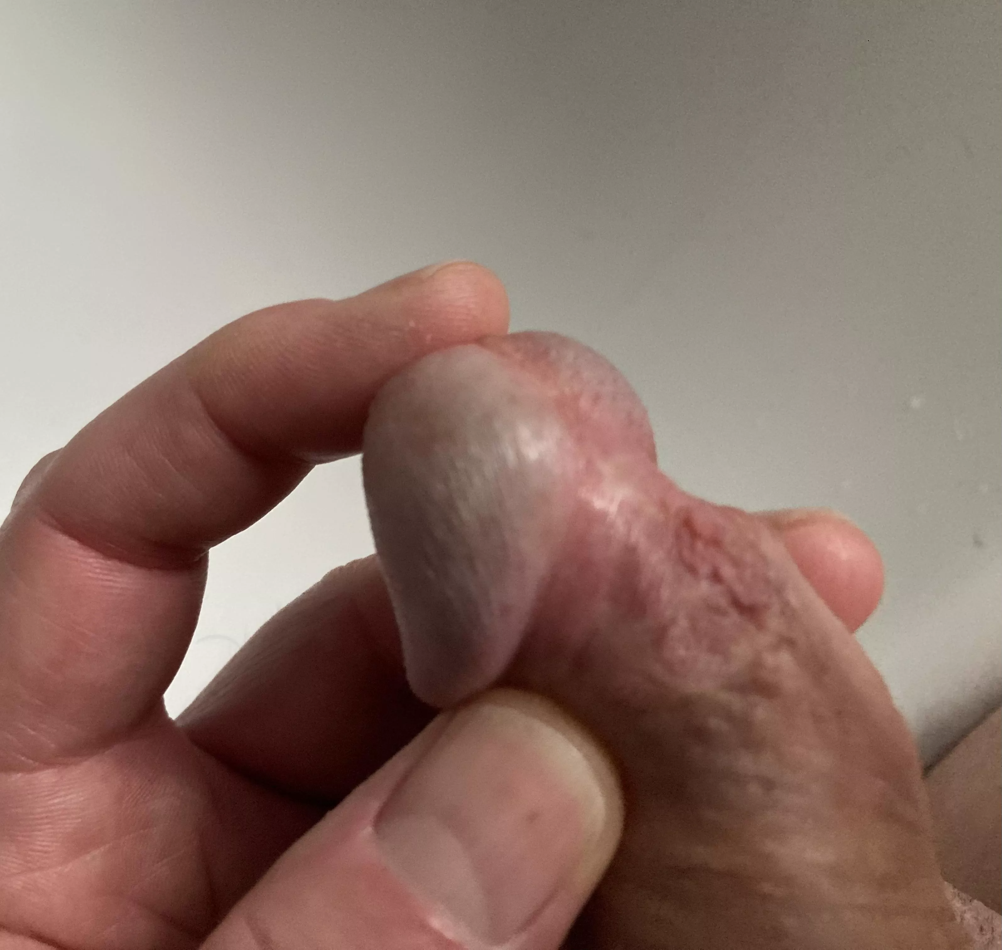 Frenulum removed after circumcision