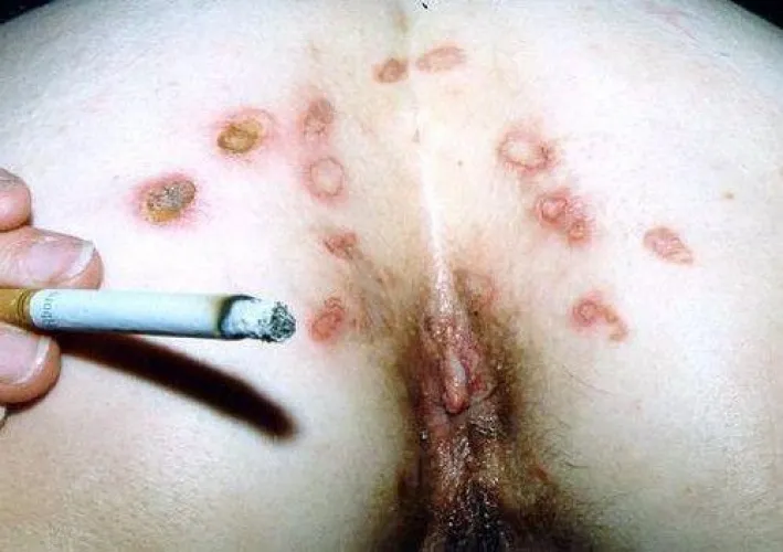 Smoking is dangerous.. for more than one reason