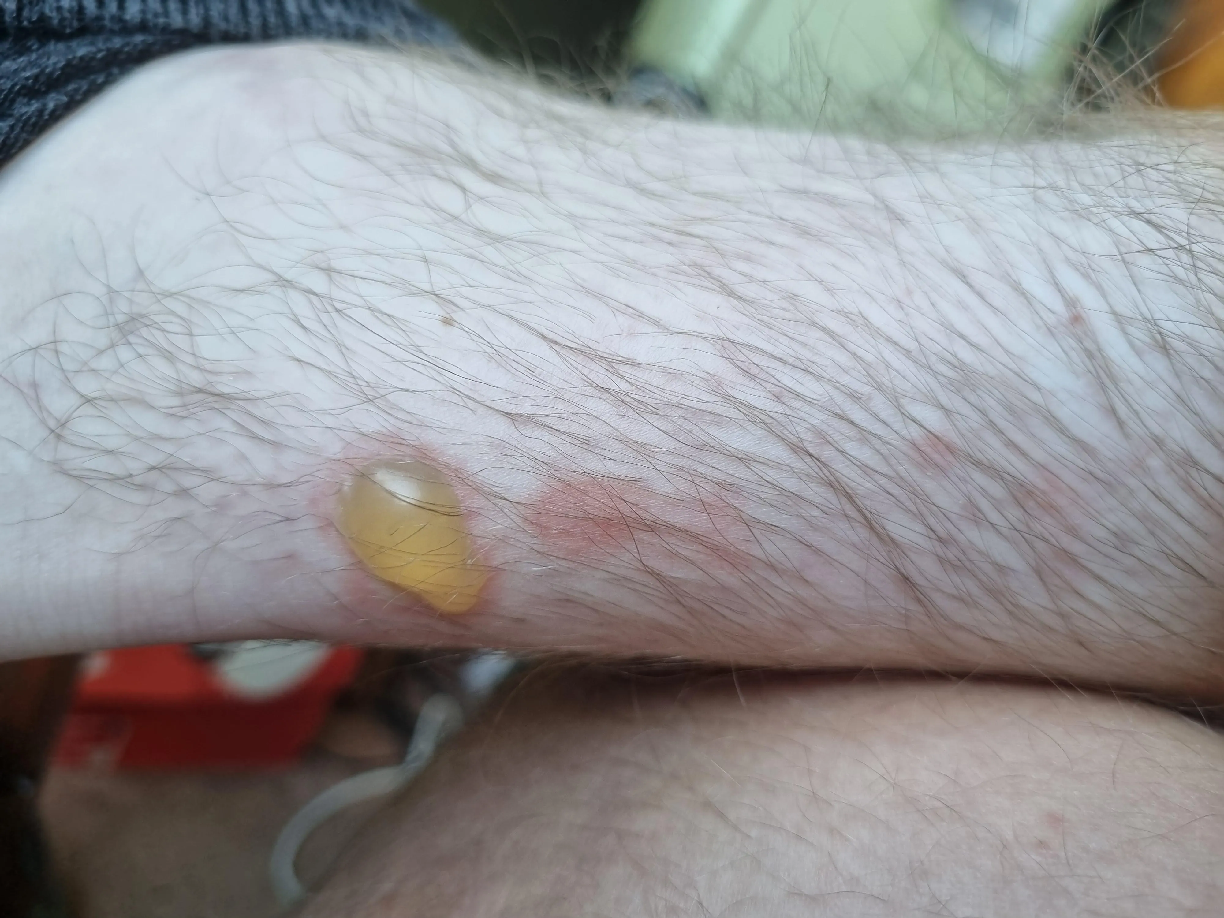 Got Chemical burn on my ankle at work today, figured this group would enjoy it 