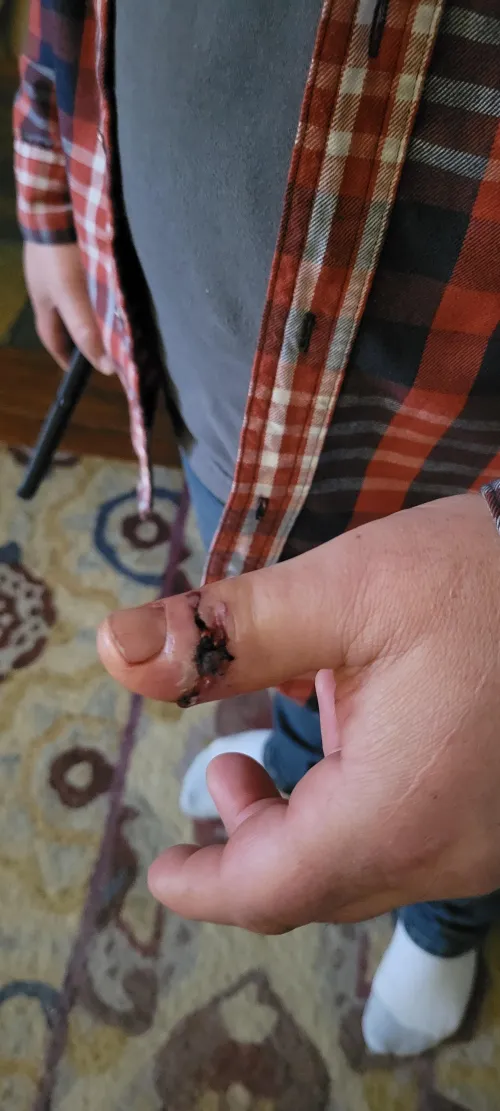 His thumb never saw it coming.