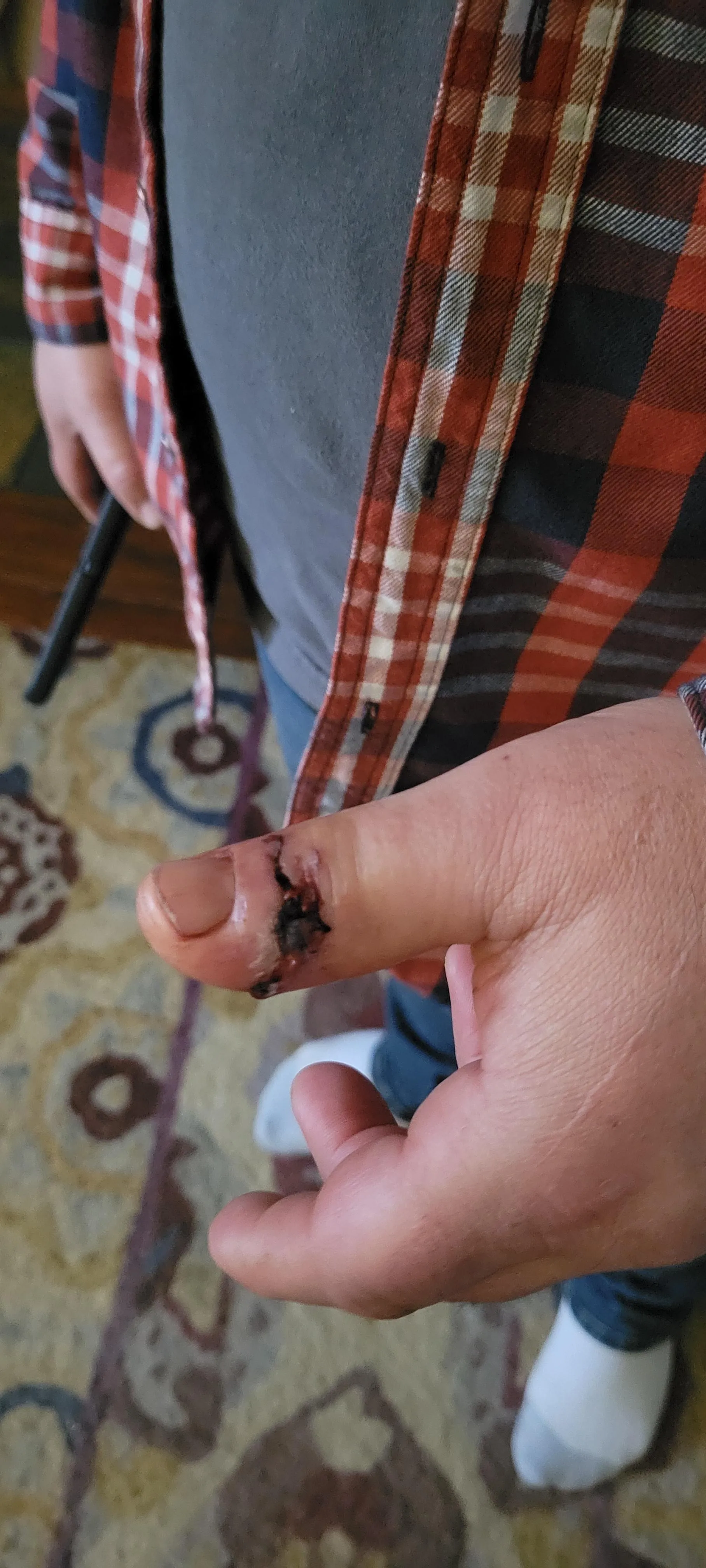 His thumb never saw it coming.