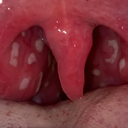 If that ain’t the most beautiful tonsillitis pic you’ve seen 