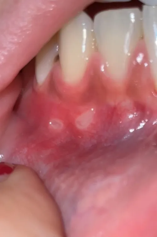 Two canker sores on my gum right next to each other