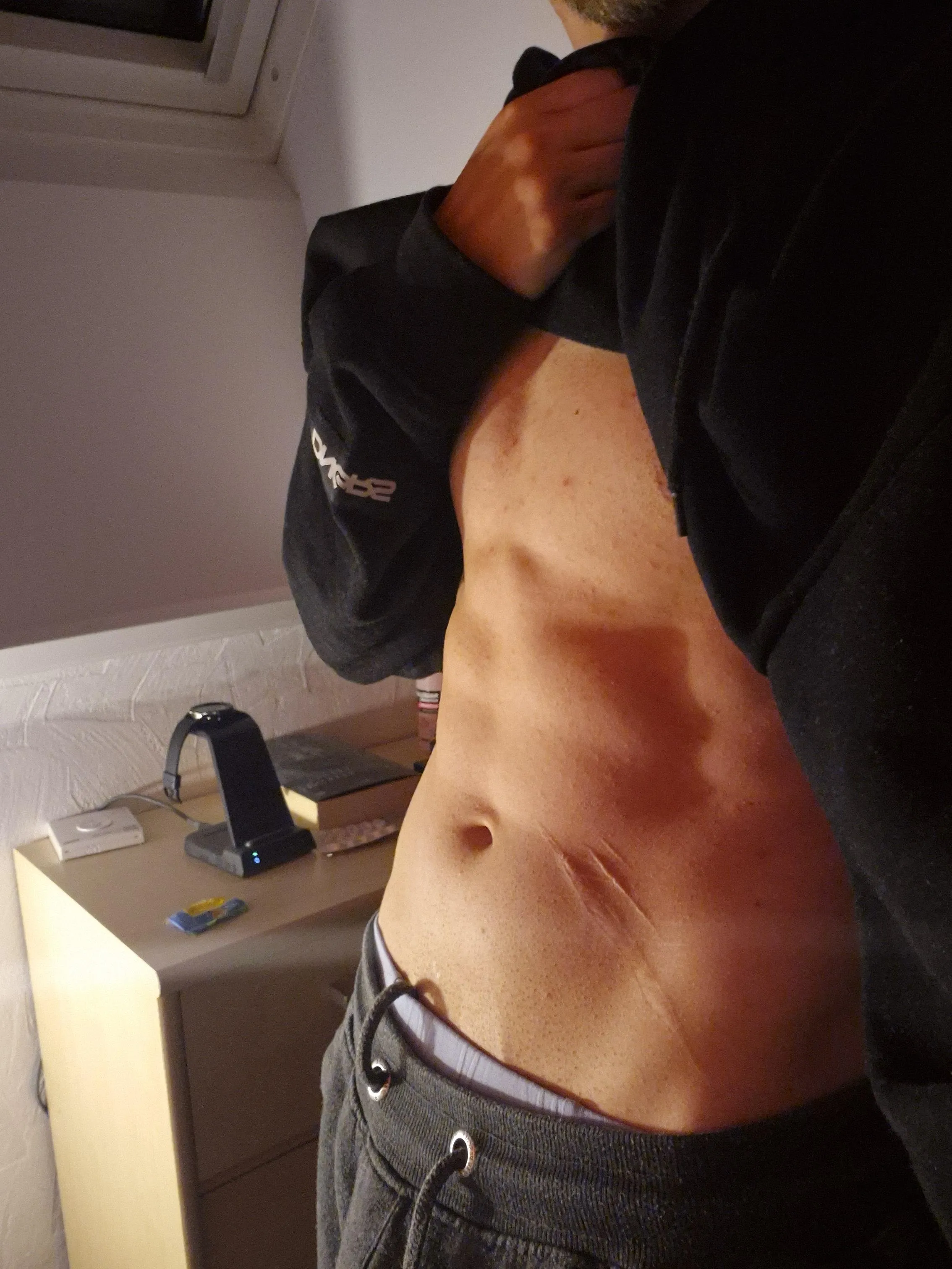 One of my bigger Scars