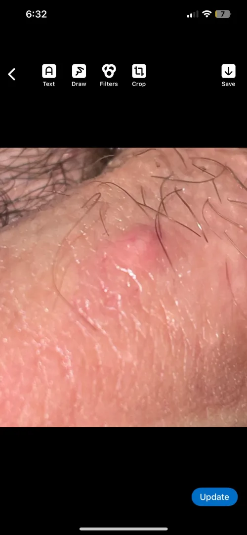 Bump on my private area i noticed around 2 days ago 19M.