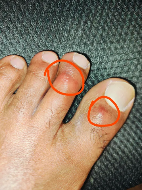 Red spots appearing on toes. Itches a lot and it hurts a little when I press on the toes.