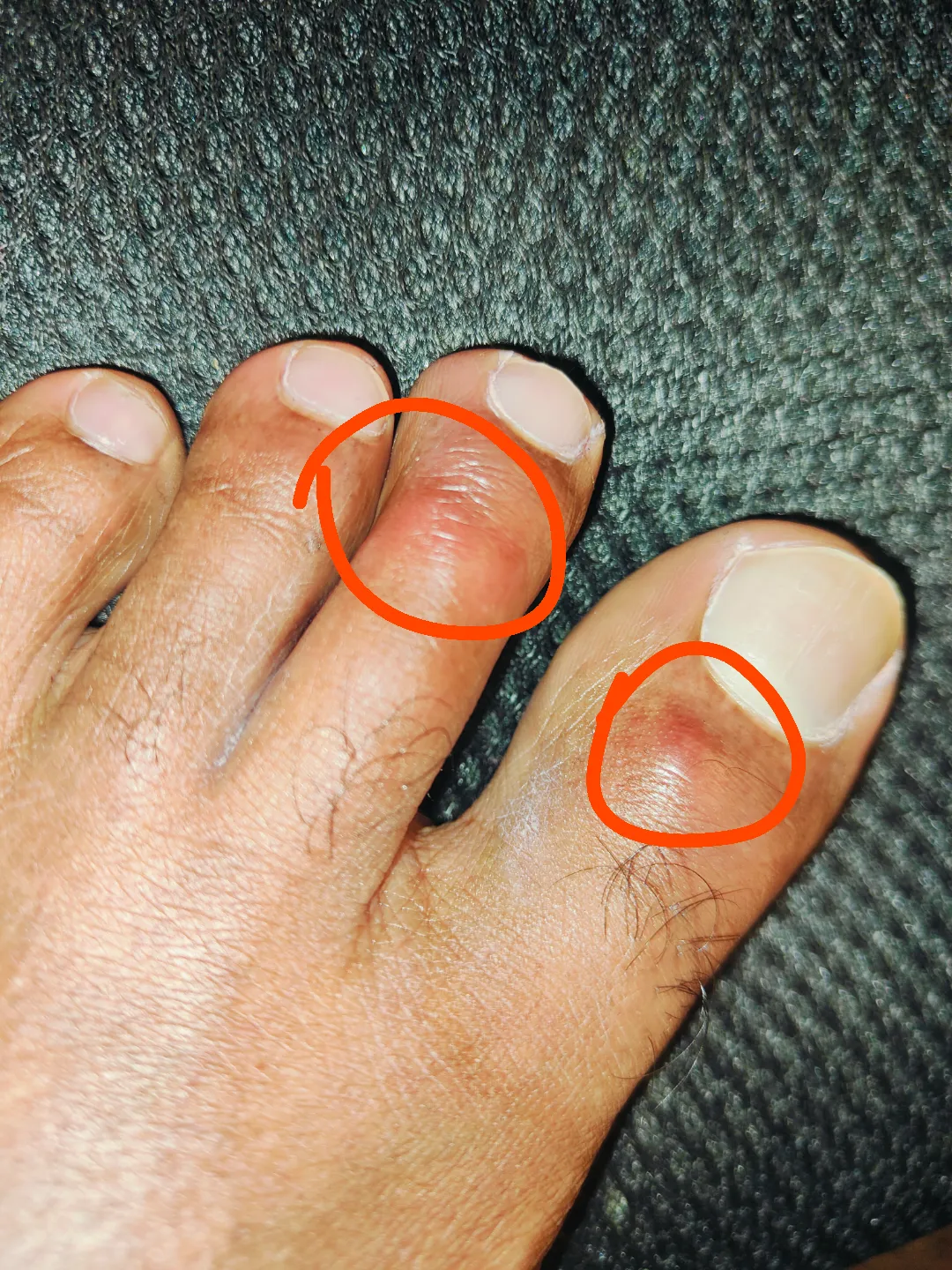 Red spots appearing on toes. Itches a lot and it hurts a little when I press on the toes.