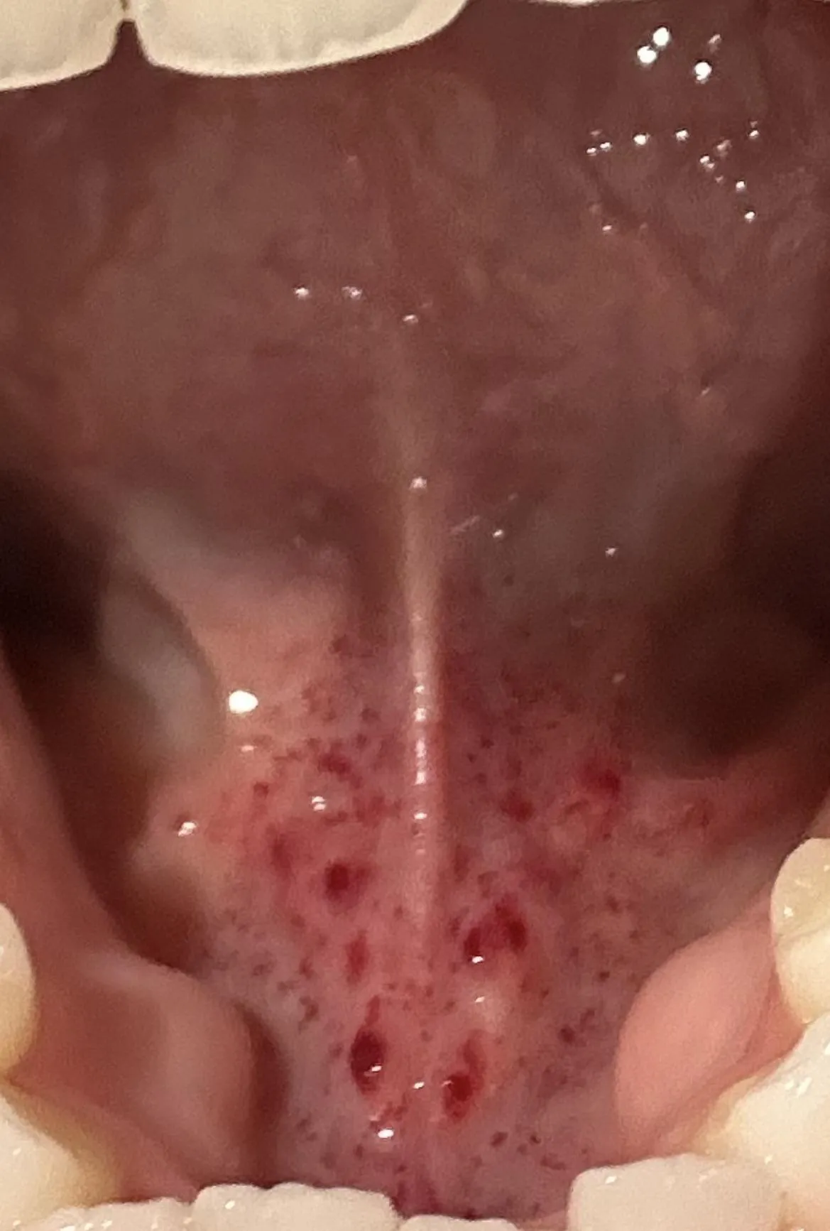 What are these red specks and blood blister looking things under my tongue?
