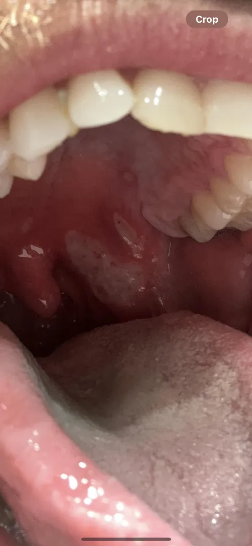 Frost burn on throat