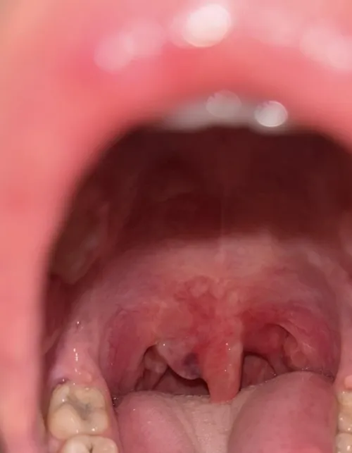 My nitrous burn looks different then everyone else’s. (Picture)