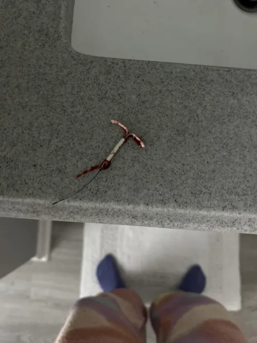 iud slipped out