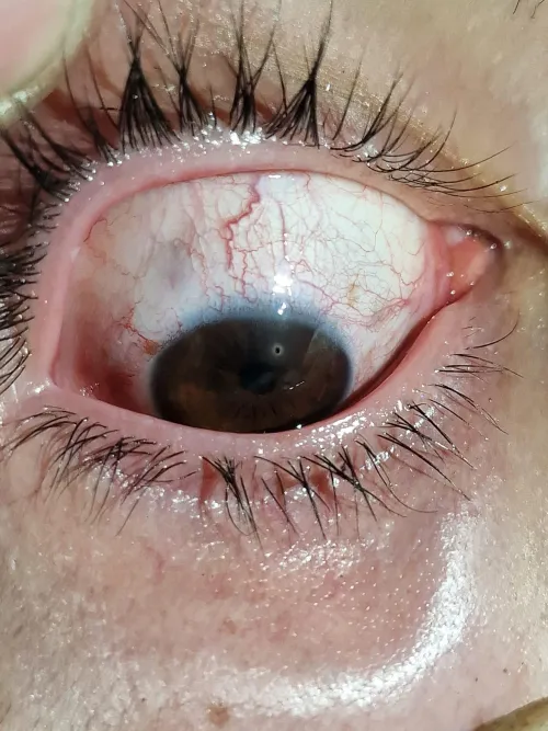 Small burning splatter hit my eye while grindig.