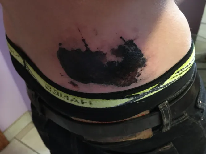 Took a spill in a bonfire