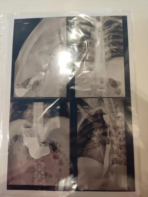 X-ray of my esophagus came, didn't know it was that bad