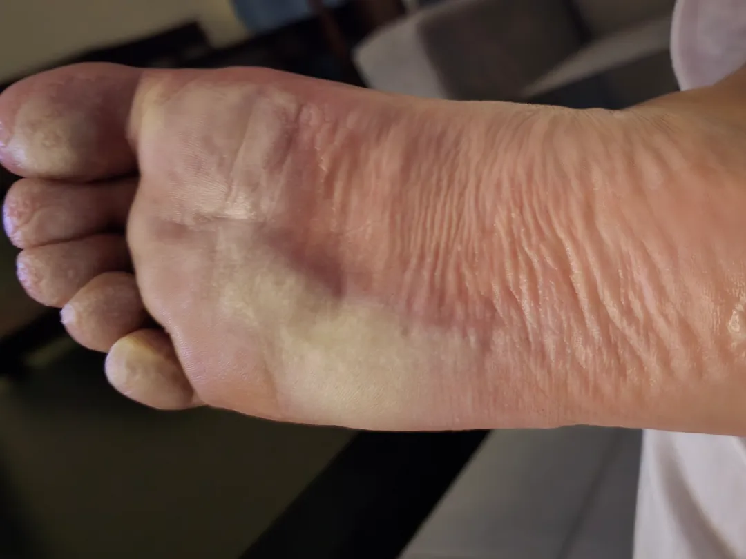 For months now my foot has been hurting and looking like this, What's wrong with my foot?