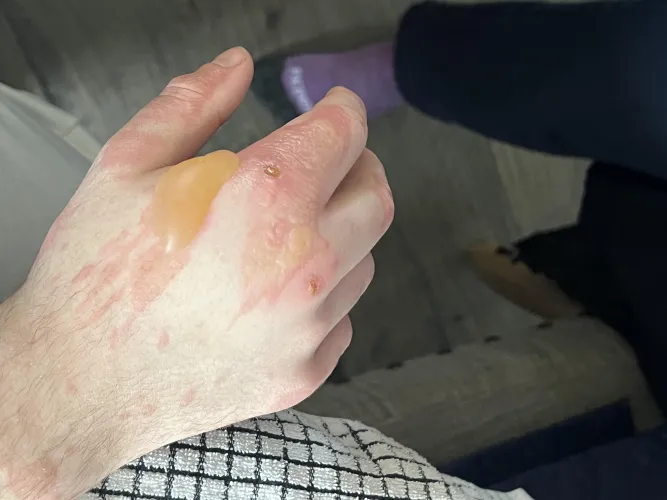 I got a very bad burn at work on Friday. I went to urgent care within an hour of it happening.