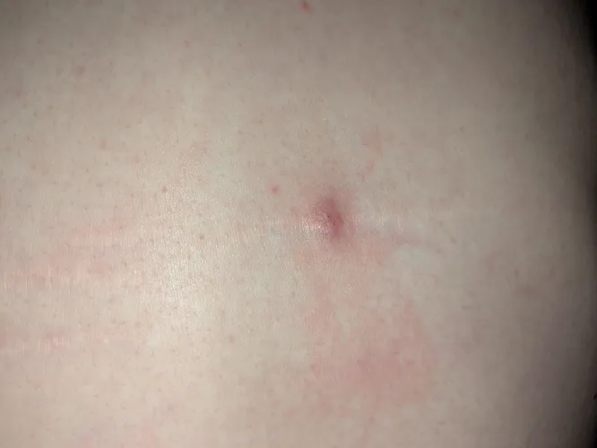 Noticed this raised, red mark on my back a few days ago. It feels sort of like a blister with he loose skin and fluid. It hurt slightly when I first noticed but not much anymore. Current theory is spider bite? Any ideas/advice?