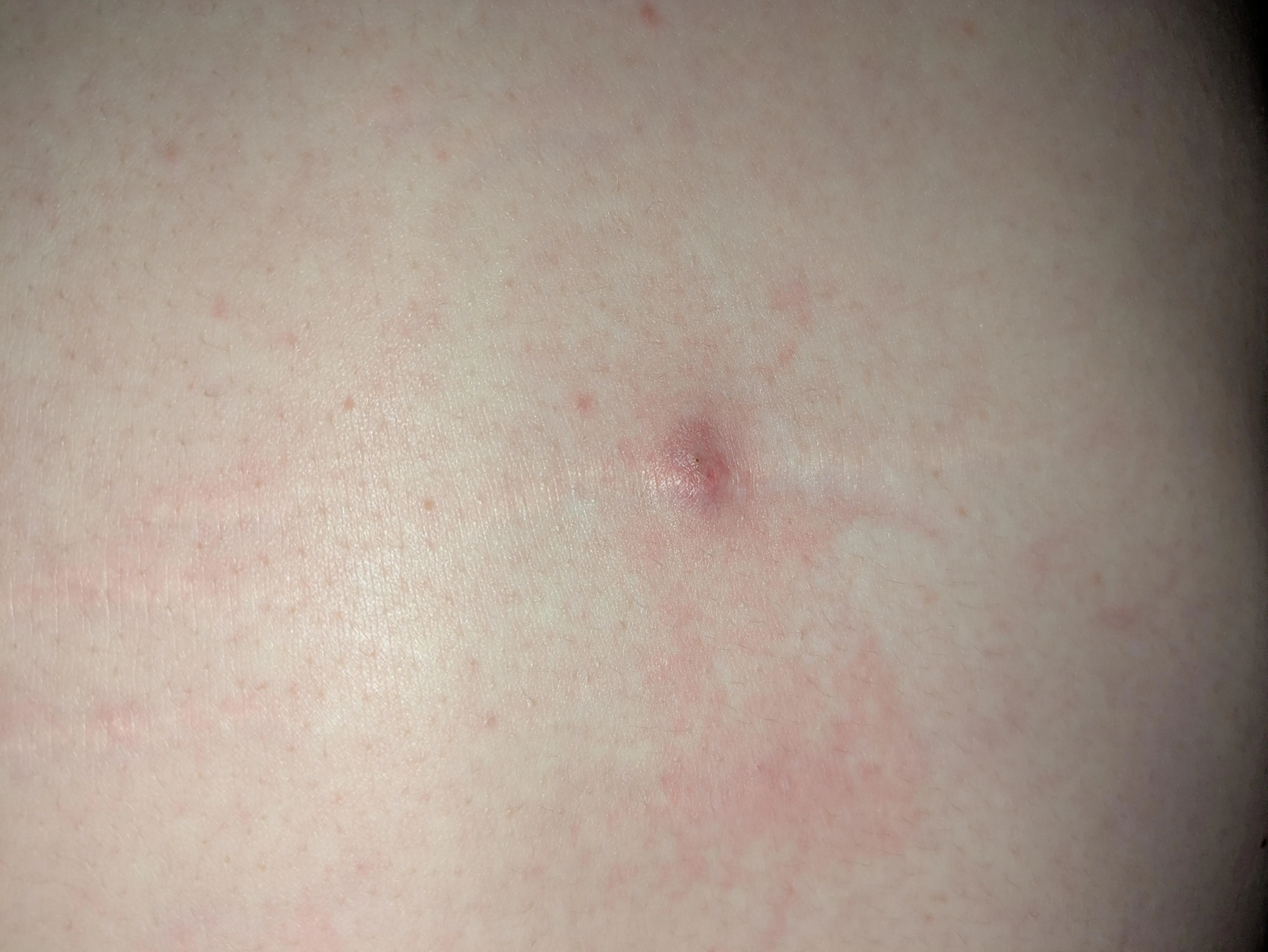 Noticed this raised, red mark on my back a few days ago. It feels sort of like a blister with he loose skin and fluid. It hurt slightly when I first noticed but not much anymore. Current theory is spider bite? Any ideas/advice? Noticed this raised, red mark on my back a few days ago. It feels sort of like a blister with he loose skin and fluid. It hurt slightly when I first noticed but not much anymore. Current theory is spider bite? Any ideas/advice?