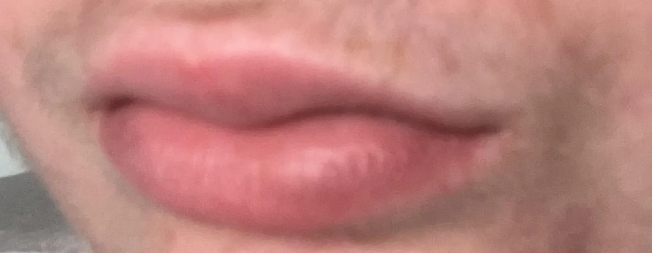 Lip fillers