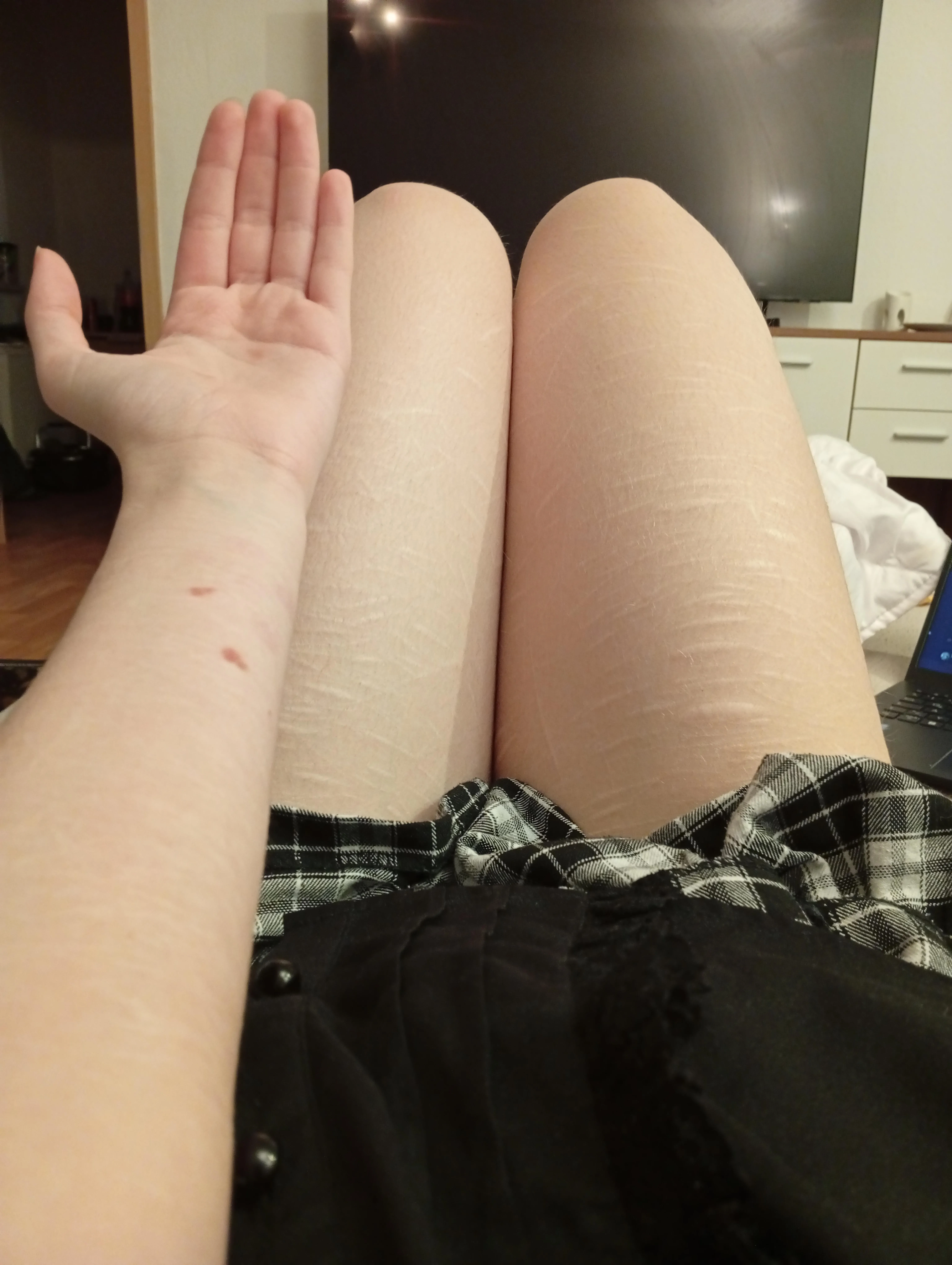 I also have burn marks