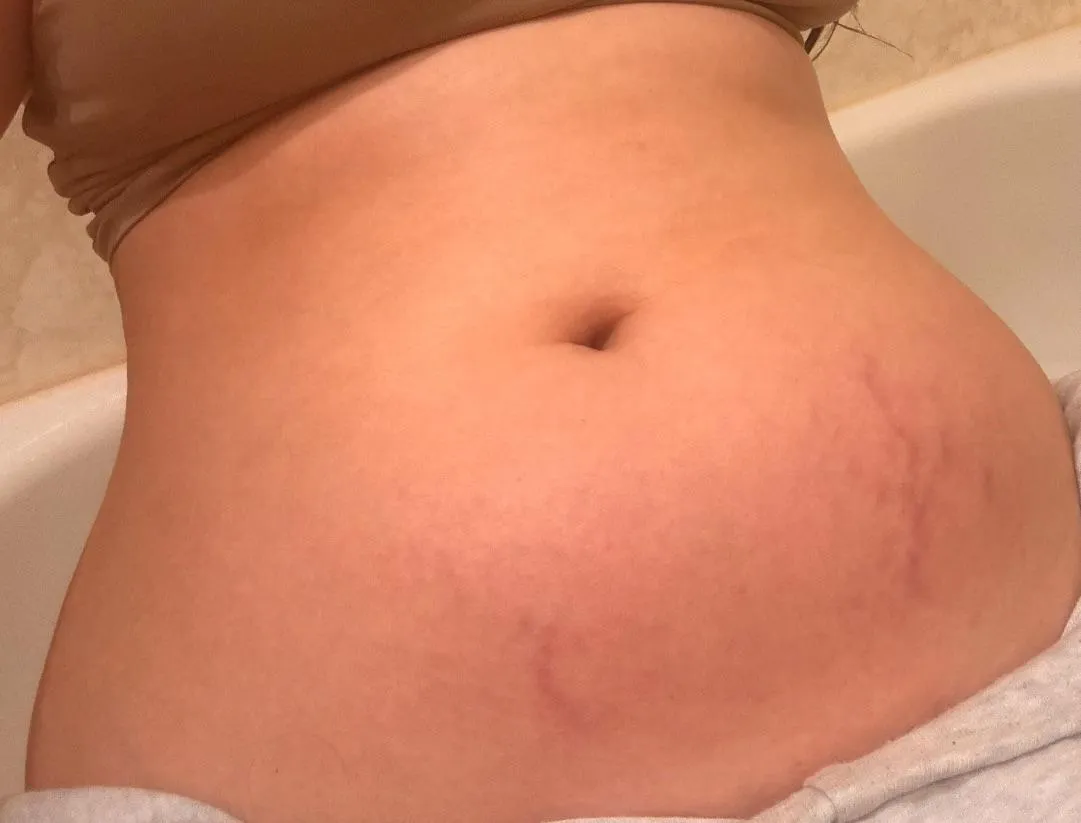 Struggling with Stretch Marks from Weight Gain – Looking for Advice to Fade Them and Boost Confidence!