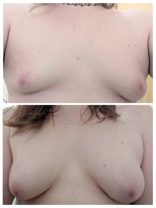 0 months gynaecomastia VS 13 months E2 monotherapy.