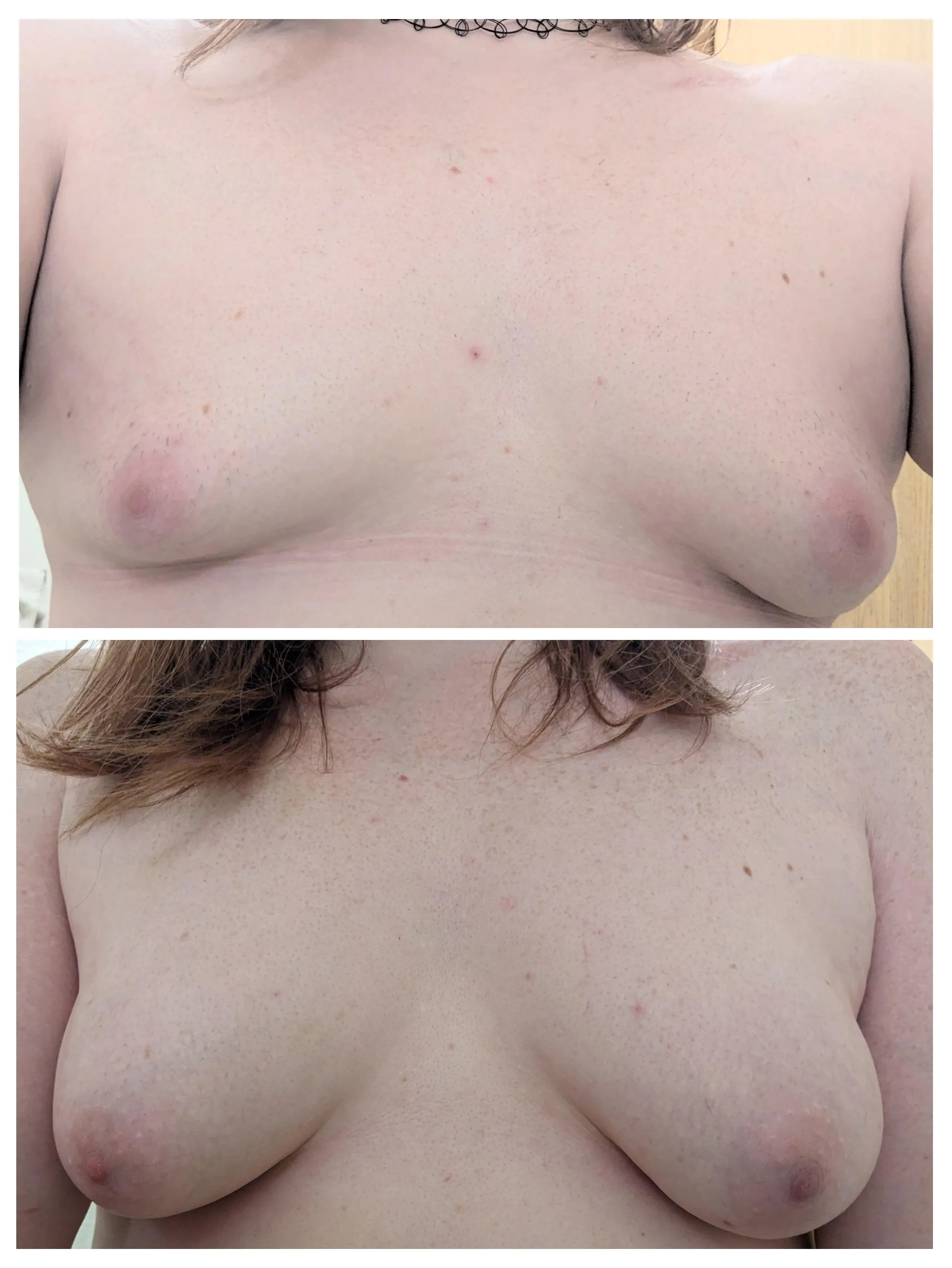 0 months gynaecomastia VS 13 months E2 monotherapy.