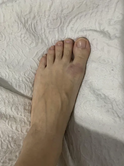 Poor this Japanese gym feet, yesterday dropped off disk on her feet