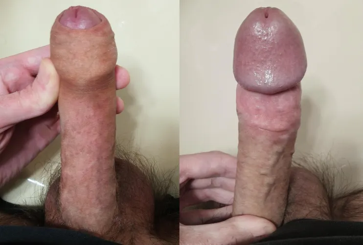 8 months after my circumcision (26 years old)