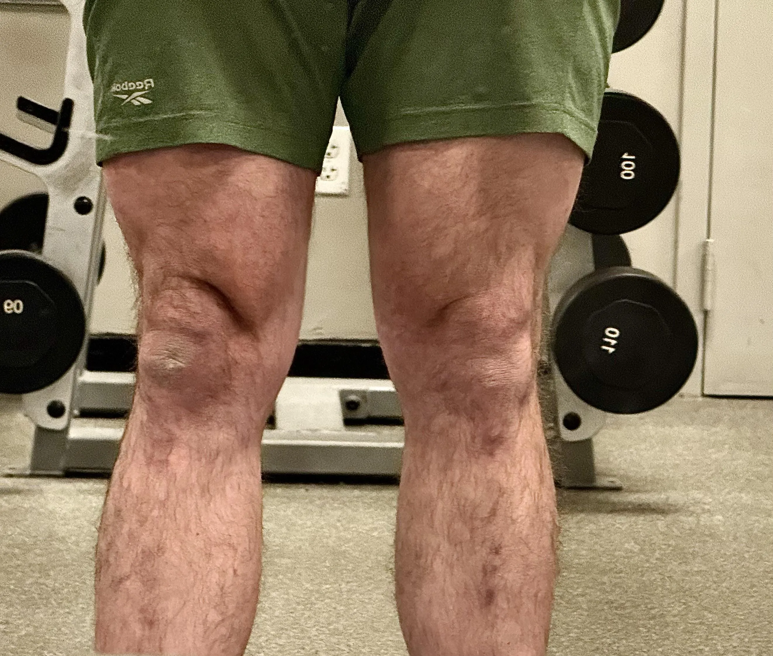 I am a 34M physique athlete with a deep indentation along the medial aspect of my left knee that I cannot seem to get rid of.