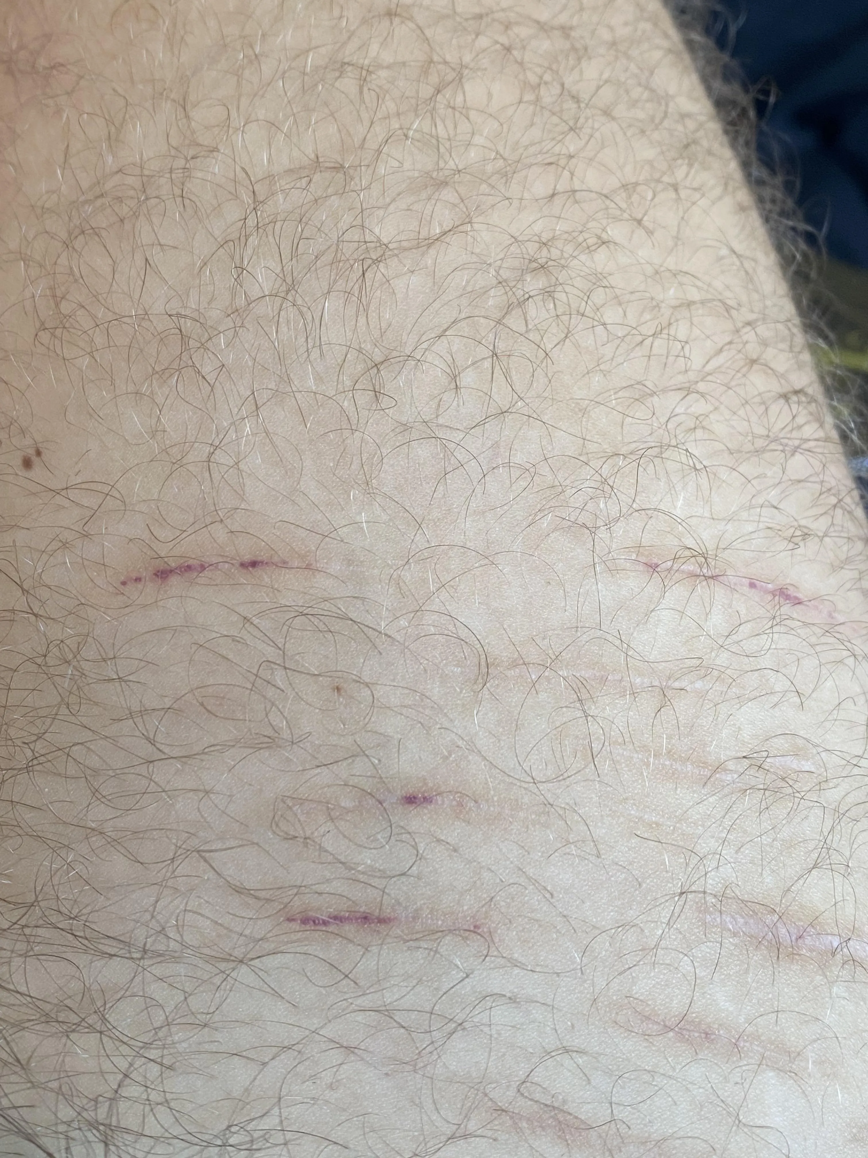 very old scars have very suddenly become visible again (they’re usually white)