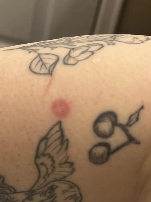 Weird dot on my arm with cross like thing in the middle- No pain … Normal?