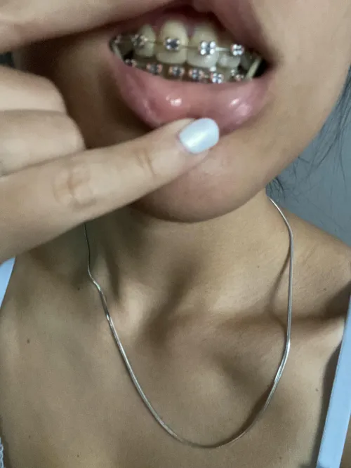 Enjoying the gummies of my braces