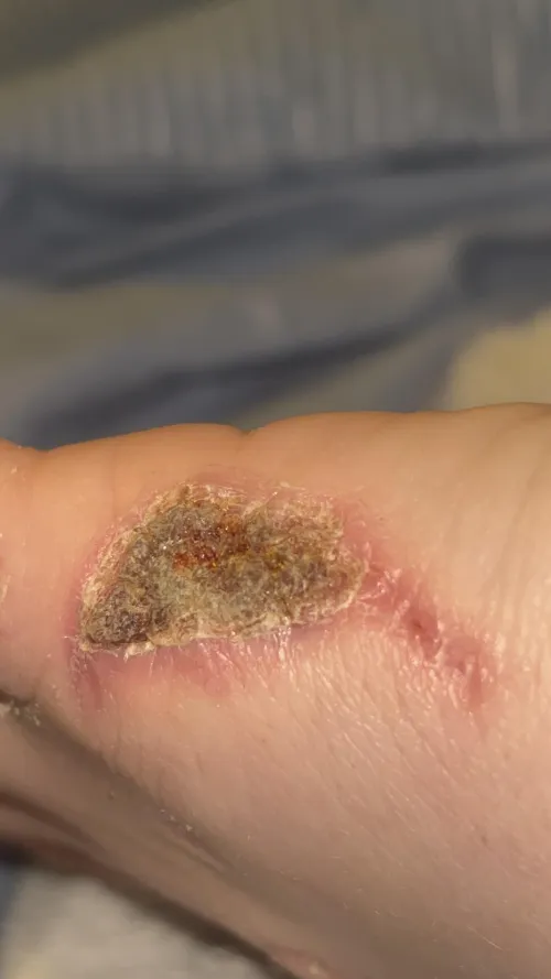 I just wanna know if this scab looks normal google is terrifying me