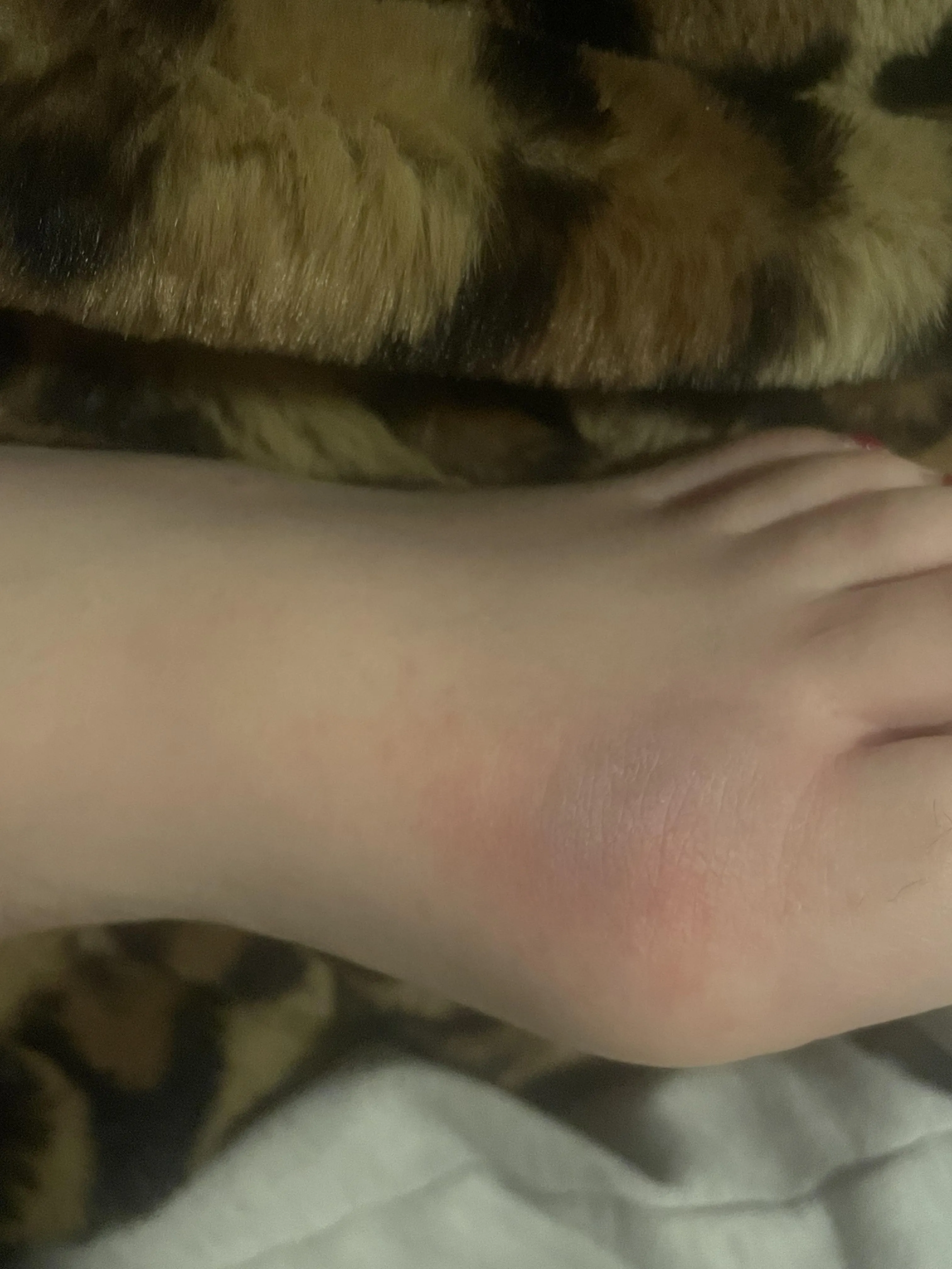 I overestimated myself & dropped a heavy piece of furniture on my foot. Do you think it’s fractured?