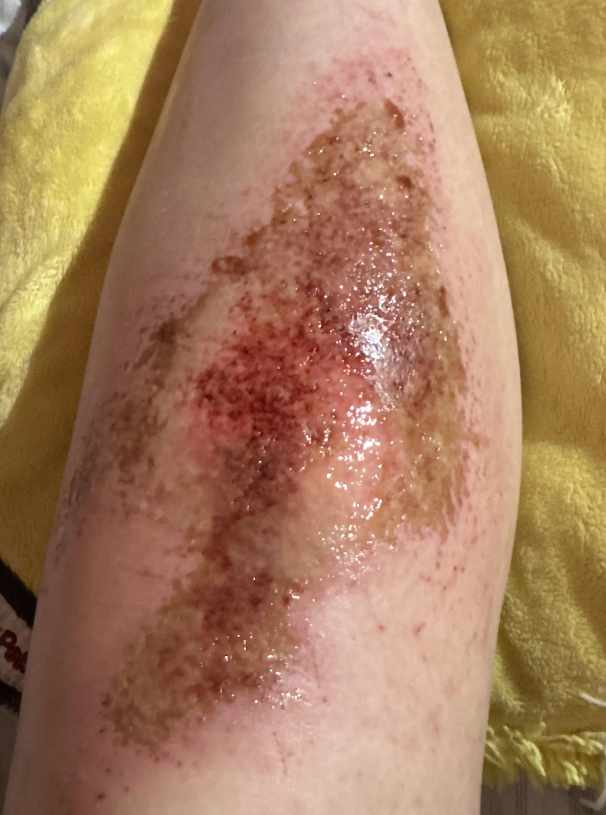 Severe Turf Burn. Need some general advice on care management for early wound.