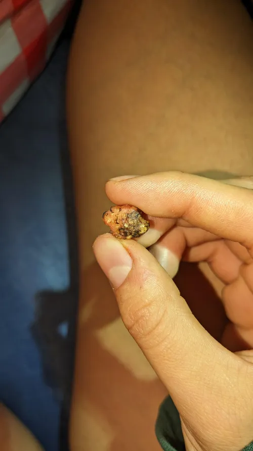 Strange rock-like object was in my leg as long as I can remember. What is it?