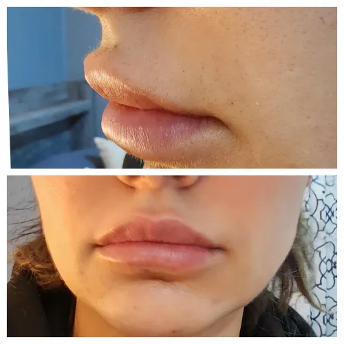 Botched lip filler. RESTYLANE DEFYNE horrible!