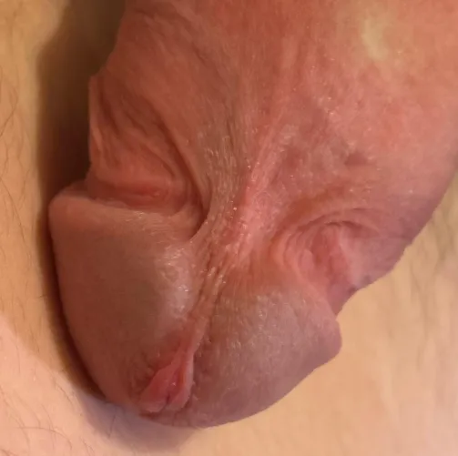 What method should I use to remove my frenulum?