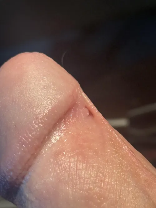 thinking of getting my frenulum removed. it's been torn for four months