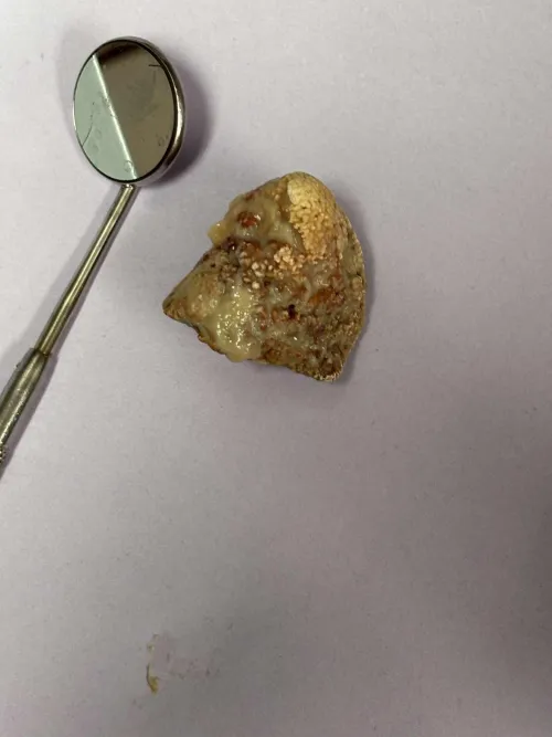 My friend said an old lady who doesn’t wash her teeth came into his dental office and had this in her mouth…