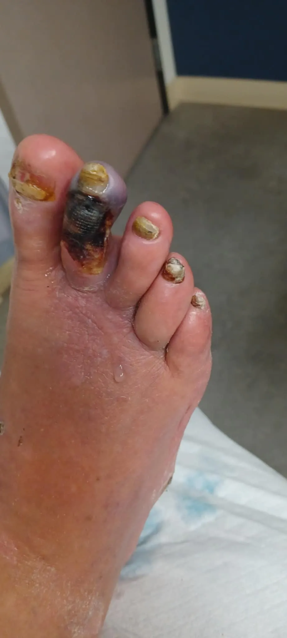 My grandpa dropped a log on his toe and didn't tell anyone for 3 months